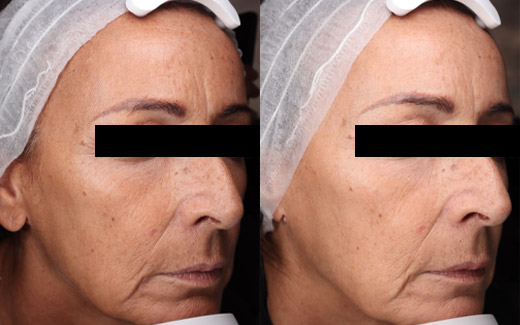 Collagen
