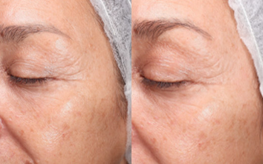 Collagen