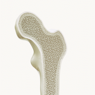 alt="Animazione 3D di una sezione trasversale ossea che mostra una struttura interna porosa che diventa meno densa, illustrando la perdita di resistenza ossea.»