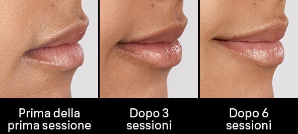 Immagine che mostra 3 ingrandimenti di labbra di donna in 3 momenti diversi del trattamento. Dopo la prima sessione, dopo 3 sessioni e dopo 6 sessioni per evidenziare i risultati ottenuti.