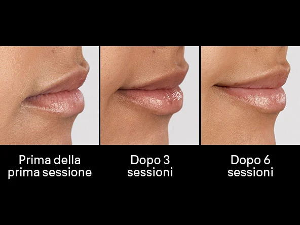 Immagine che mostra 3 ingrandimenti di labbra di donna in 3 momenti diversi del trattamento. Dopo la prima sessione, dopo 3 sessioni e dopo 6 sessioni per evidenziare i risultati ottenuti.