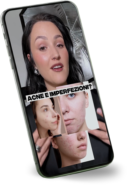Smartphone inclinato che mostra una creator mentre parla alla fotocamera. Sullo schermo sono visibili immagini ravvicinate di volti con acne e imperfezioni, accompagnate dal testo &ldquo;Acne e imperfezioni?&rdquo;.