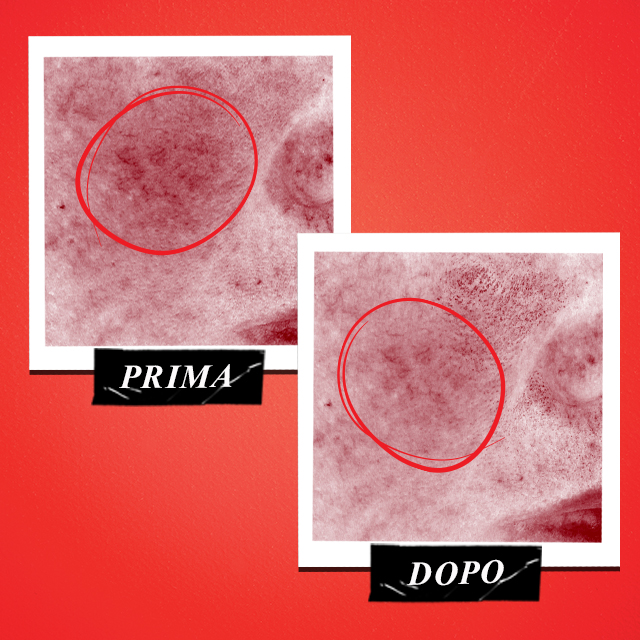 Confronto prima e dopo: primo piano della pelle del viso con rossori evidenti a sinistra e aspetto pi&ugrave; uniforme a destra; le aree interessate sono cerchiate.