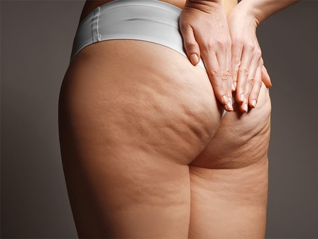 Ritenzione idrica gambe donna