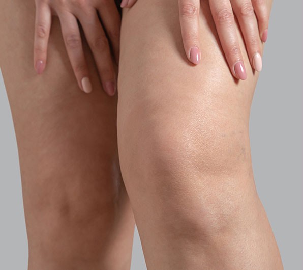 gambe gonfie