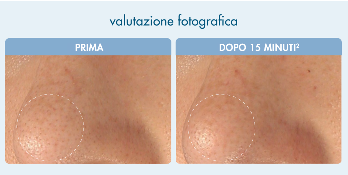 valutazione fotografica per blackhead clear duo nose mask