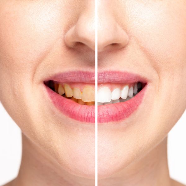 Prima e dopo Oral Biotic
