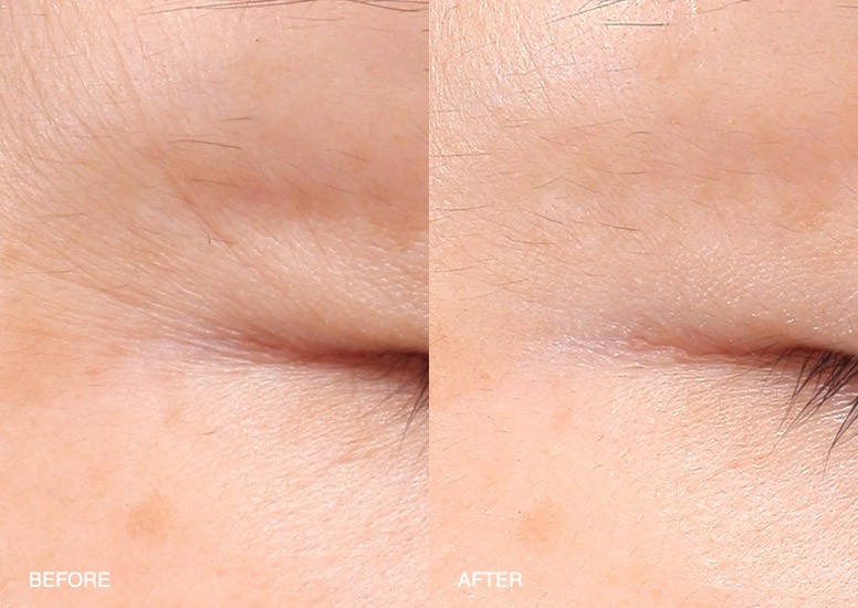 SEE HOW IT REPAIRS +73% BLURRED CROW’S FEET SELF-ASSESSMENT 62 WOMEN, 3 WEEKS